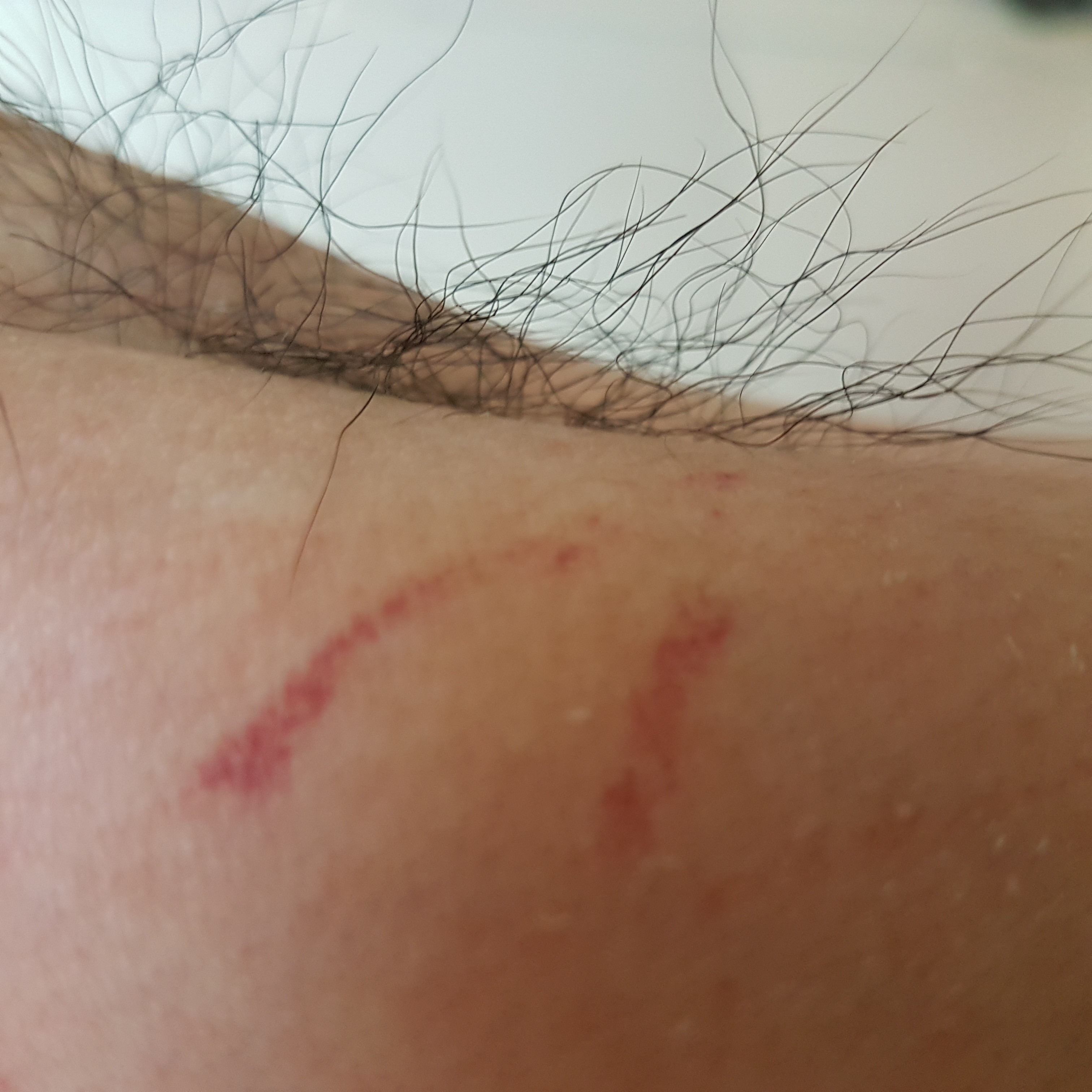 gale bouton rouge apres traitement gale bouton rouge apres traitement